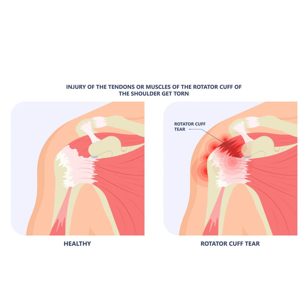 Rotator cuff injury