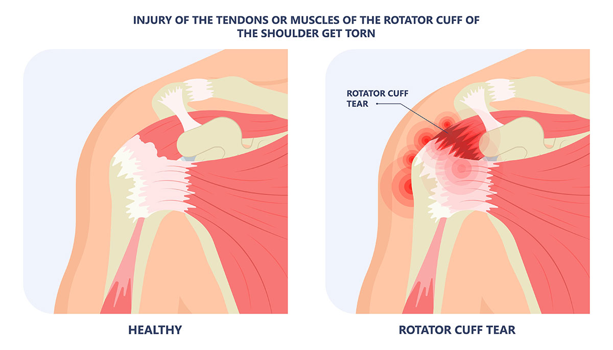 Rotator cuff injury