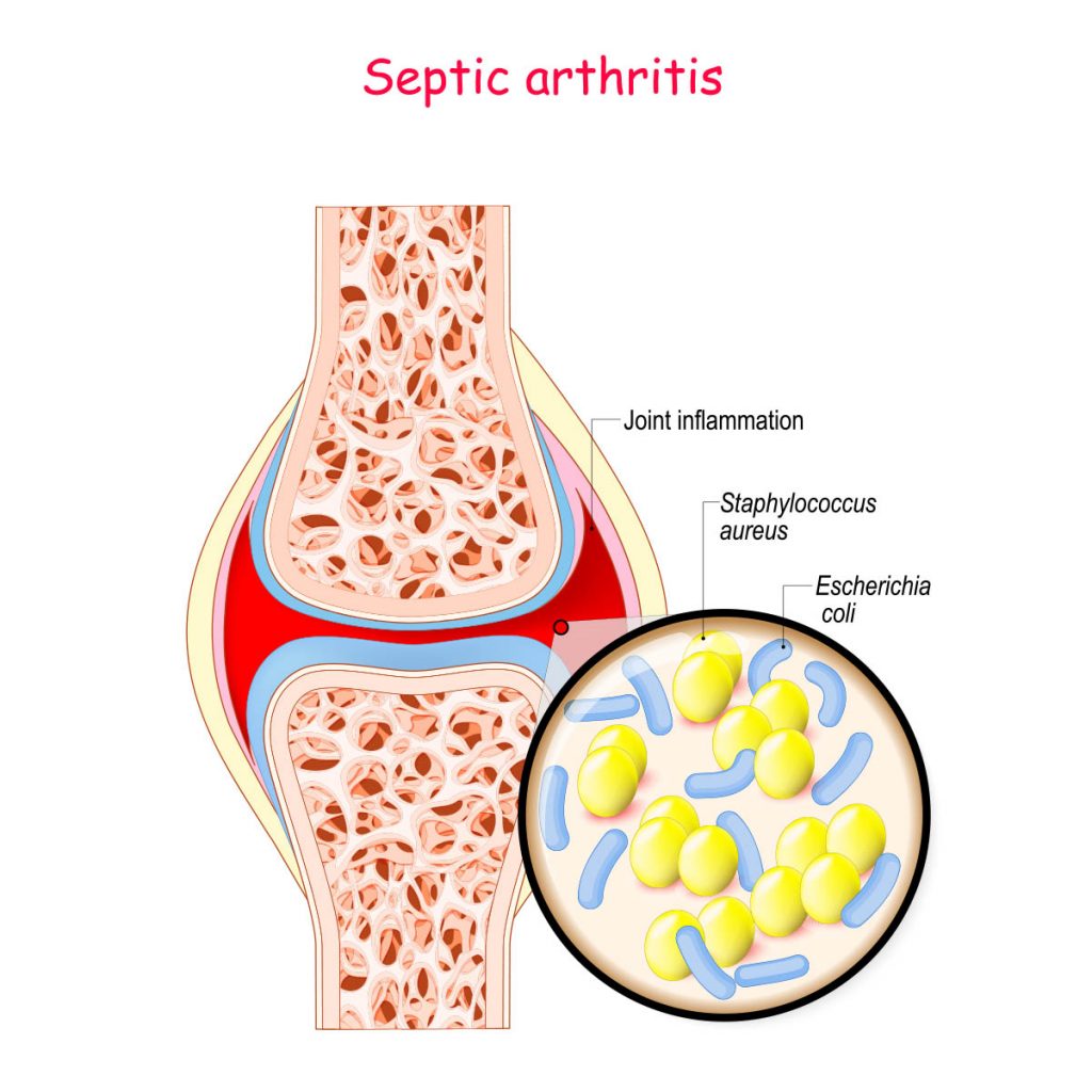 View of septic arthritis.