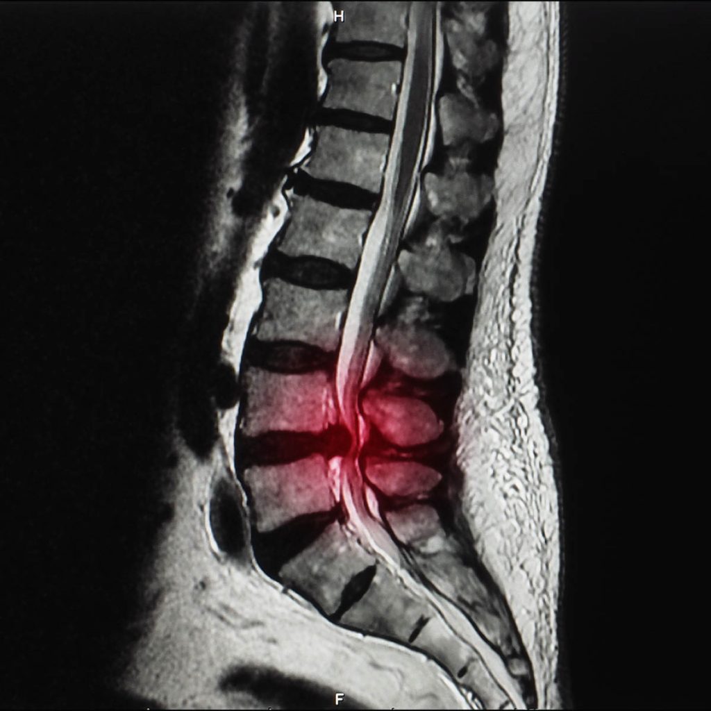 Spinal stenosis