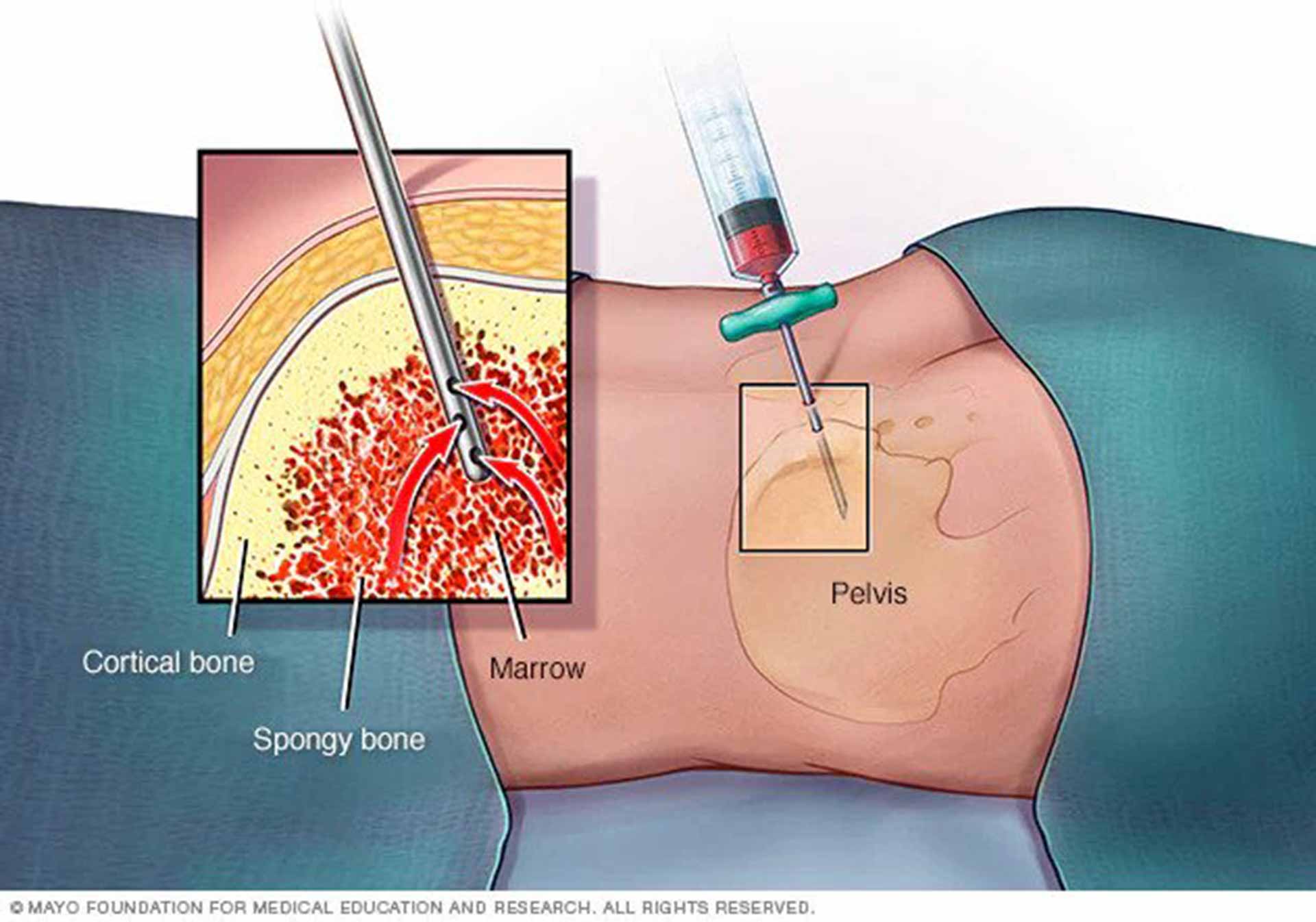 Acute lymphocytic leukemia diagnosis procedure.