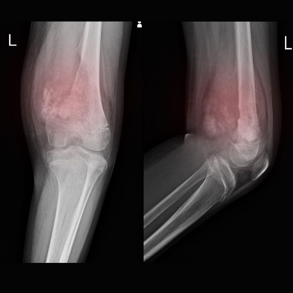 X-rays Showing Bone Cancer.