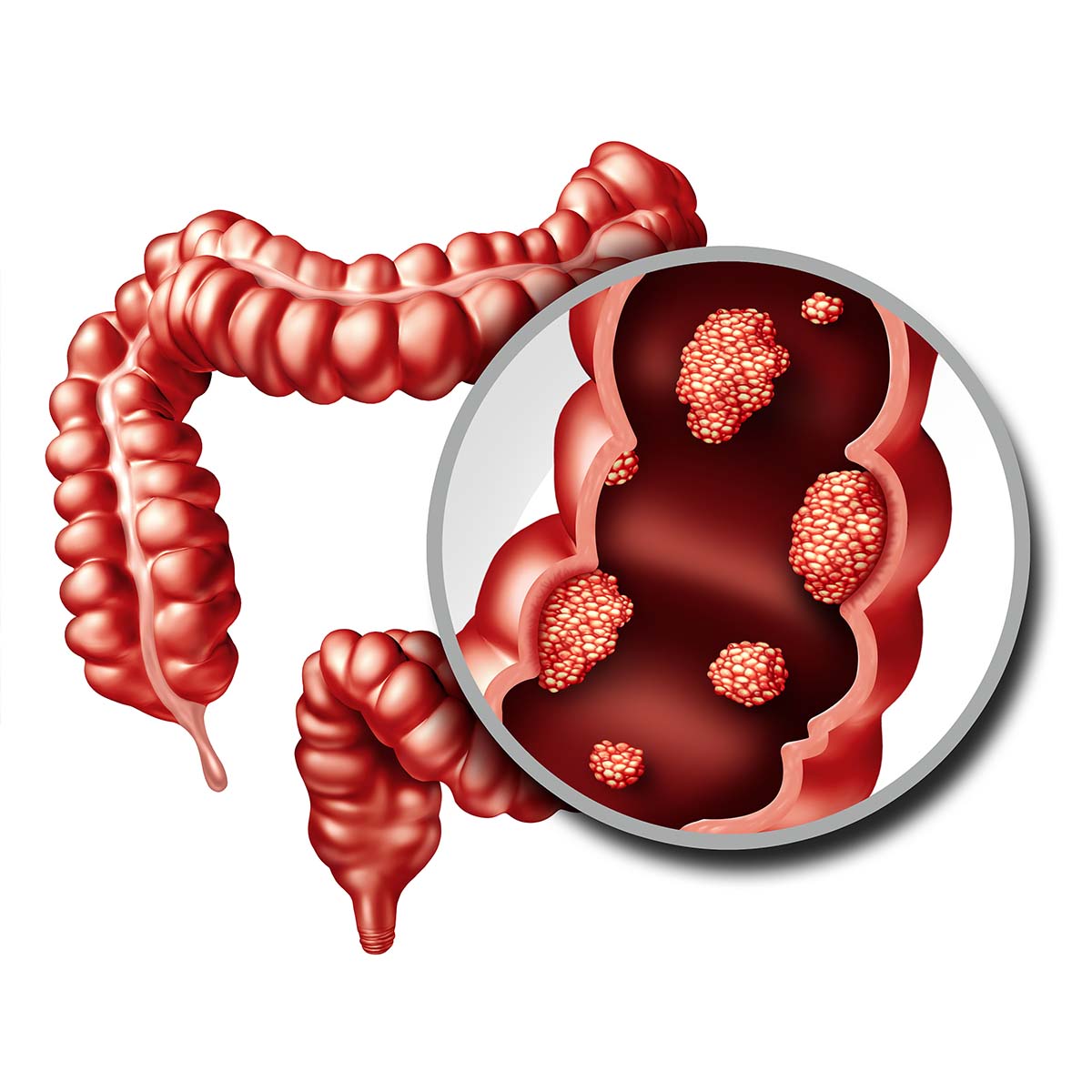 Colon cancer Vejthani Hospital JCI Accredited International