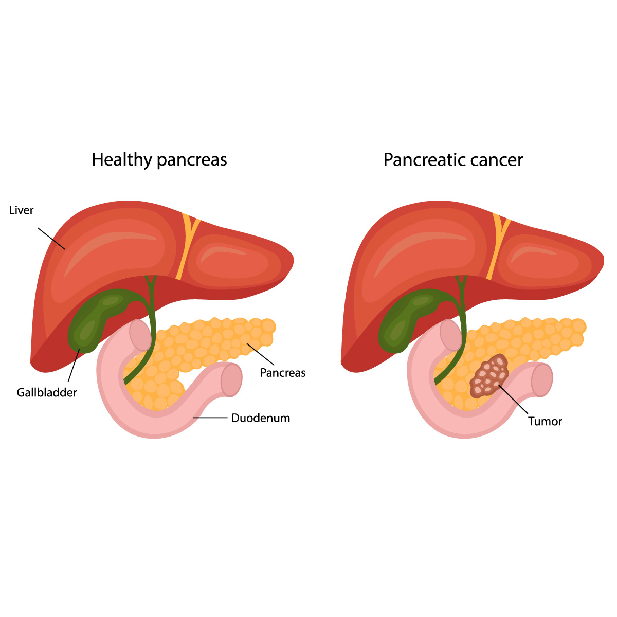 pancreas cancer