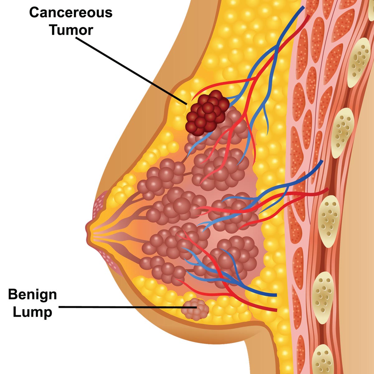 Breast cancer - Vejthani Hospital | JCI Accredited International