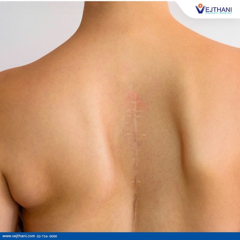 A person’s back with a scar after getting scoliosis surgery.
