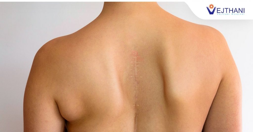 A person’s back with a scar after getting scoliosis surgery.