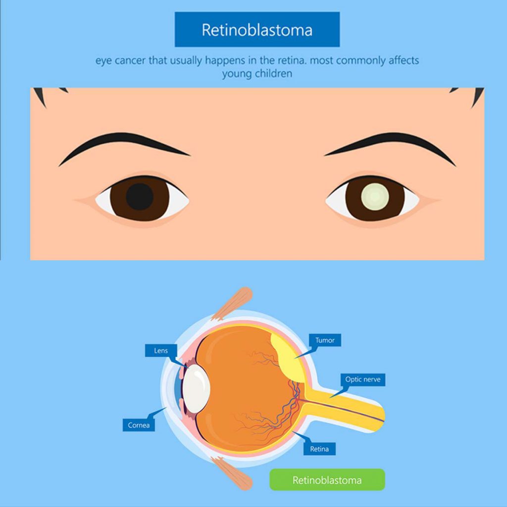 Retinoblastoma Vejthani Hospital JCI Accredited International