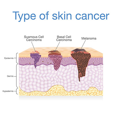 Types of skin cancer. 
