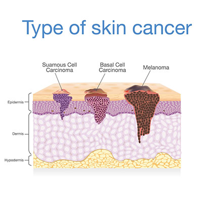 melanoma skin moles