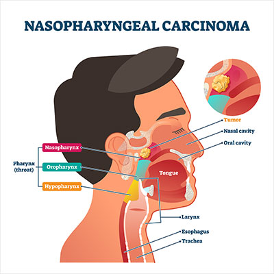 Diagram of Nasopharyngeal Carcinoma.