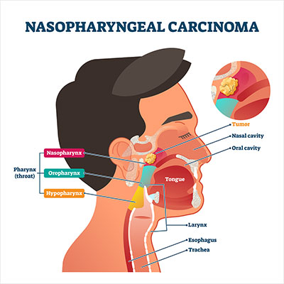 nasopharyngeal carcinoma symptoms