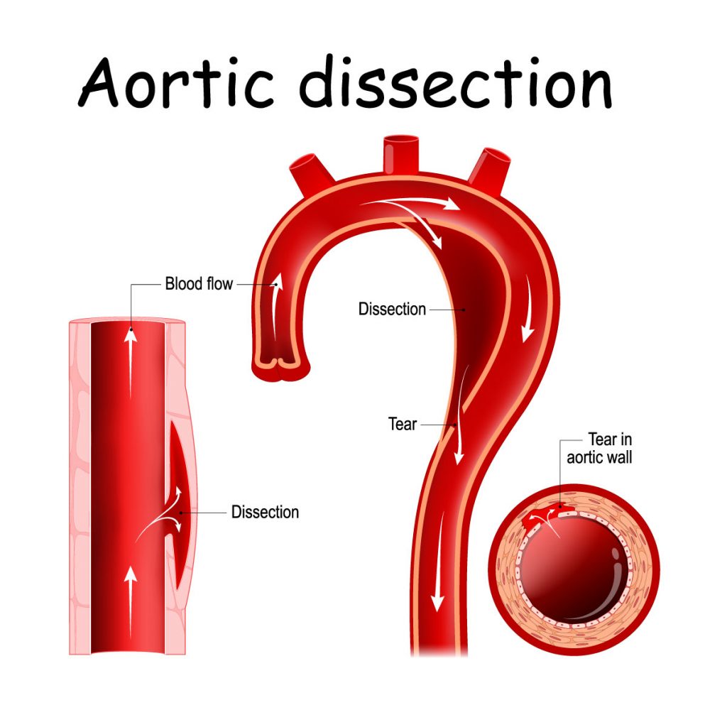 Aortic Dissection Risks And 8 Critical Symptoms Vejthani aortic-dissection-risks-and-8-critical-symptoms-vejthani