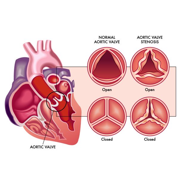 Aortic Valve Disease Causes And 2024 Insights Vejthani aortic-valve-disease-causes-and-2024-insights-vejthani