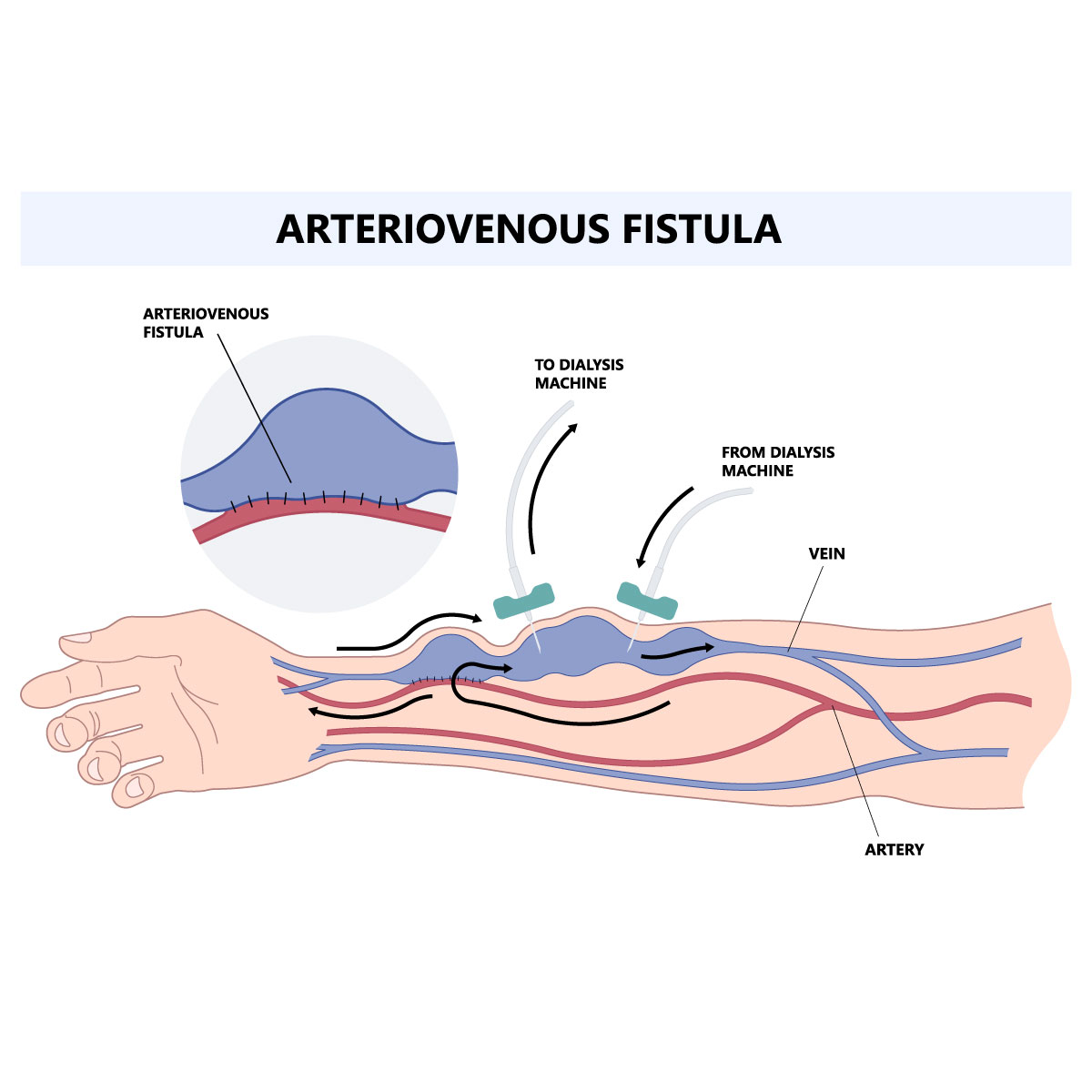 Arteriovenous fistula - Vejthani Hospital | JCI Accredited International Hospital in Bangkok, Thailand.