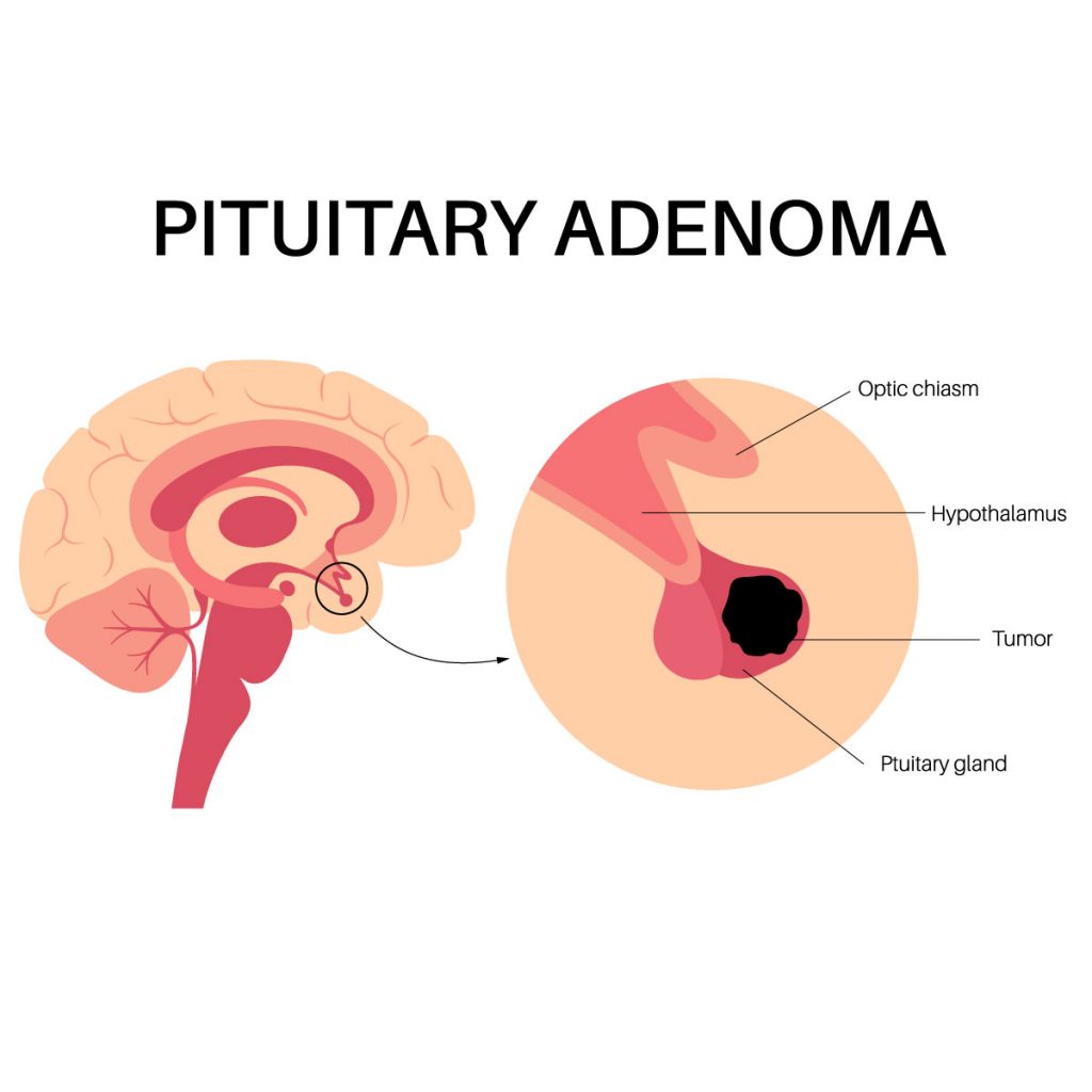 Location of a Pituitary Tumor.