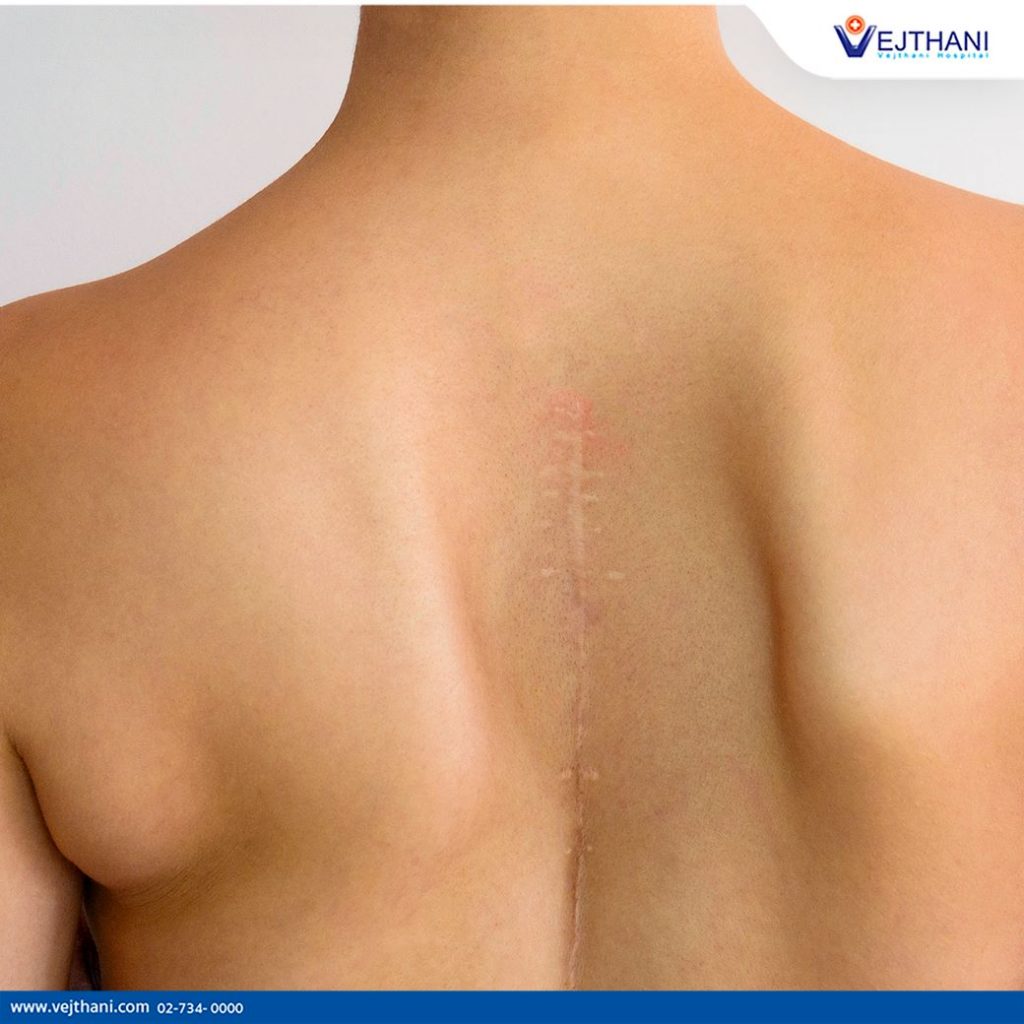 Operate Now: Scoliosis Surgery