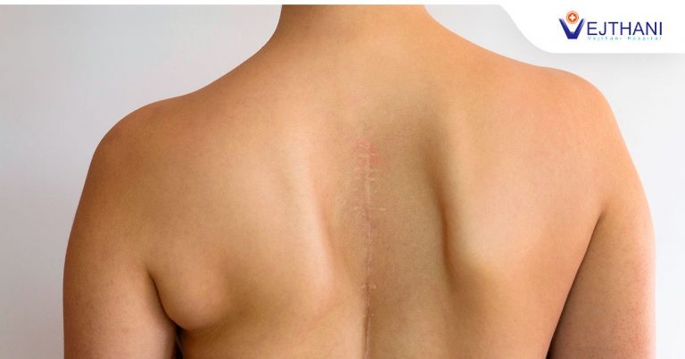 The Pros And Cons of Scoliosis Surgery