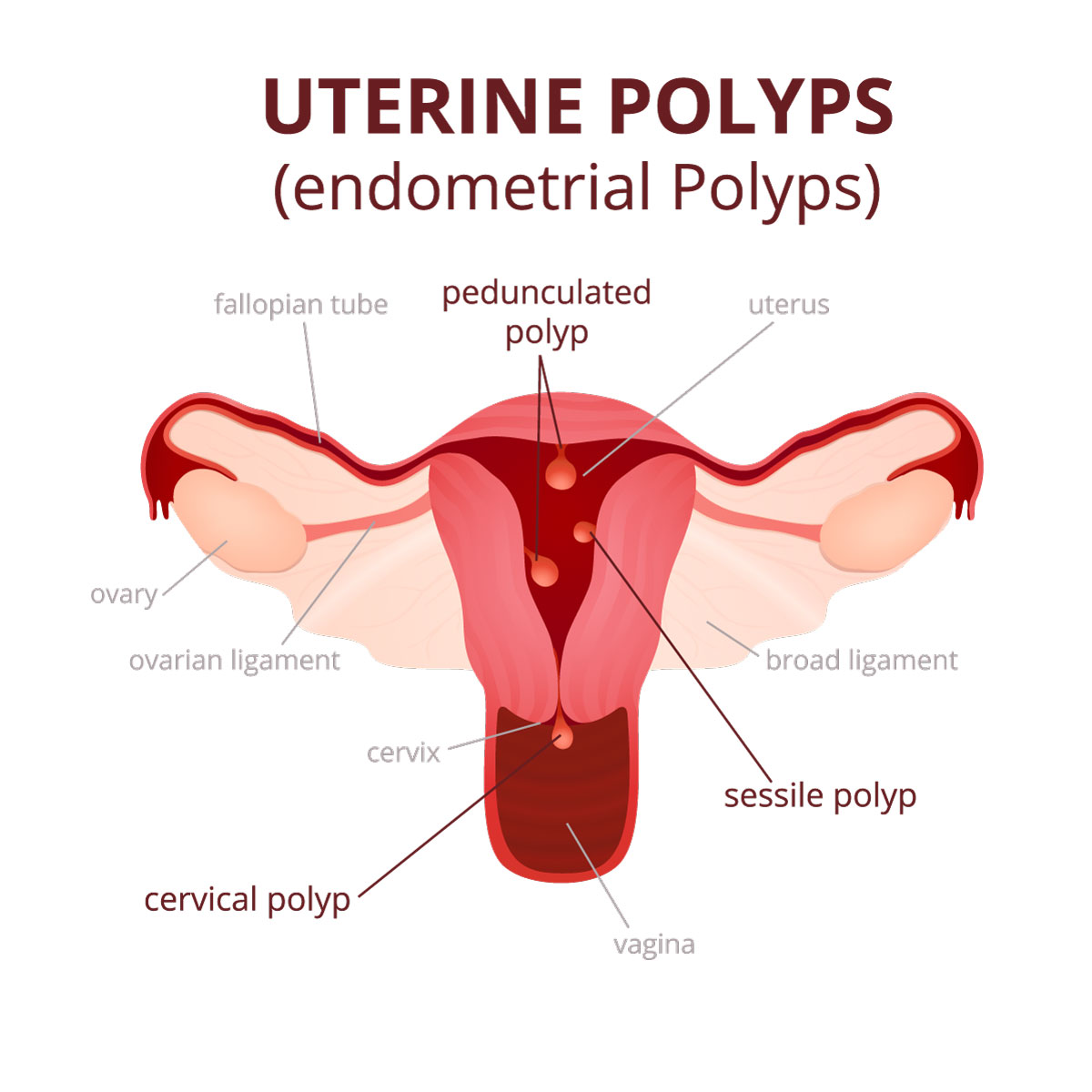 Areas Where Uterine Polyps Occur. 