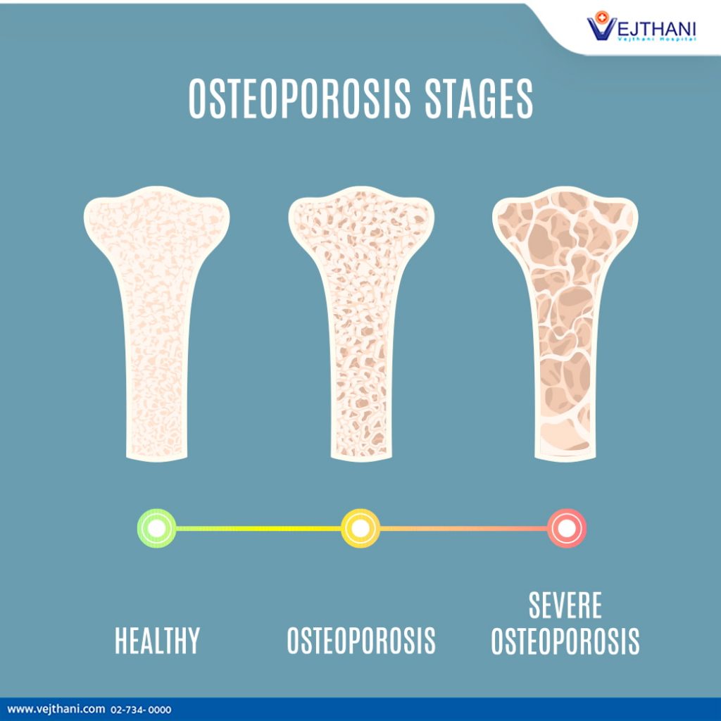 Osteoporosis means ‘porous bone’ and is a health condition that weakens bones, making them fragile and more likely to break. 