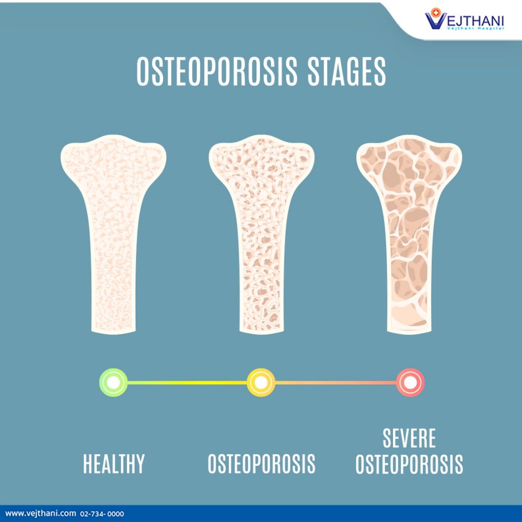 Osteoporosis means ‘porous bone’ and is a health condition that weakens bones, making them fragile and more likely to break.