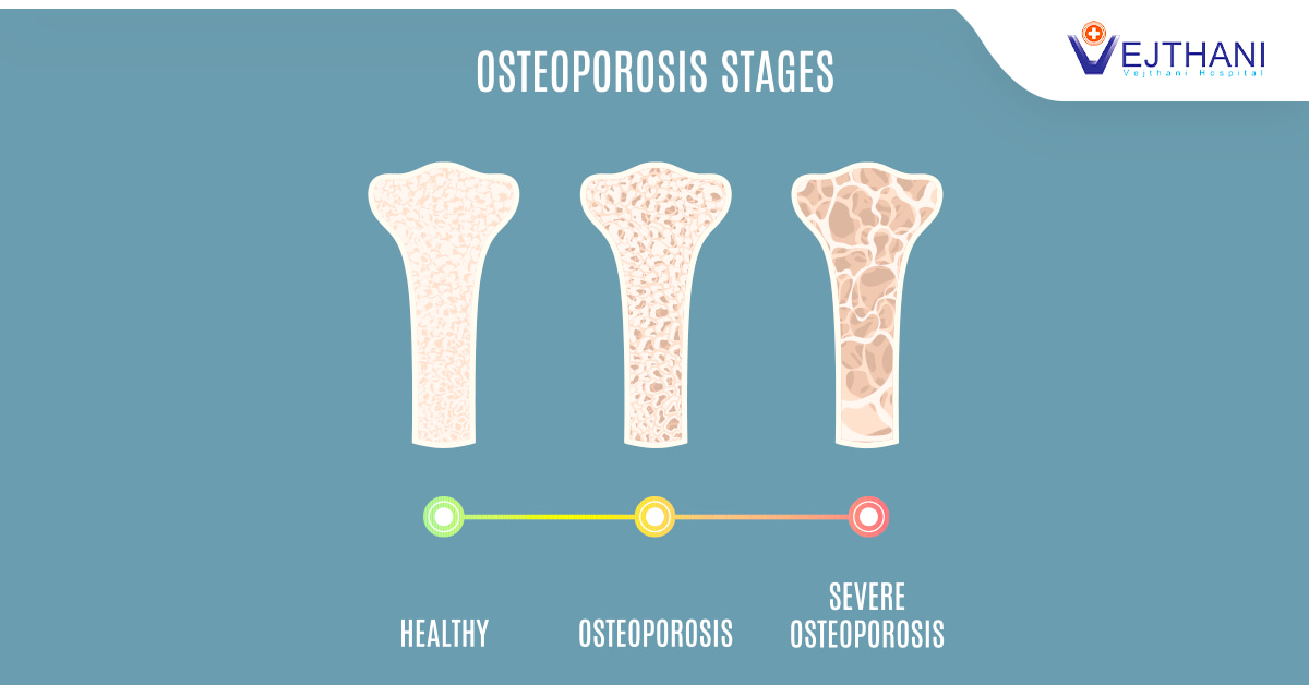 Diagnostic Tests For Osteoporosis diagnostic-tests-for-osteoporosis