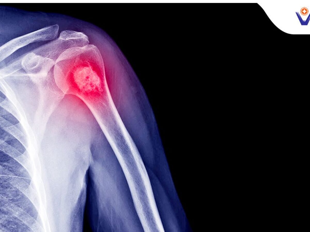 Stage 4 Of Bone Cancer Symptoms Of 4th Stage Bone Cancer