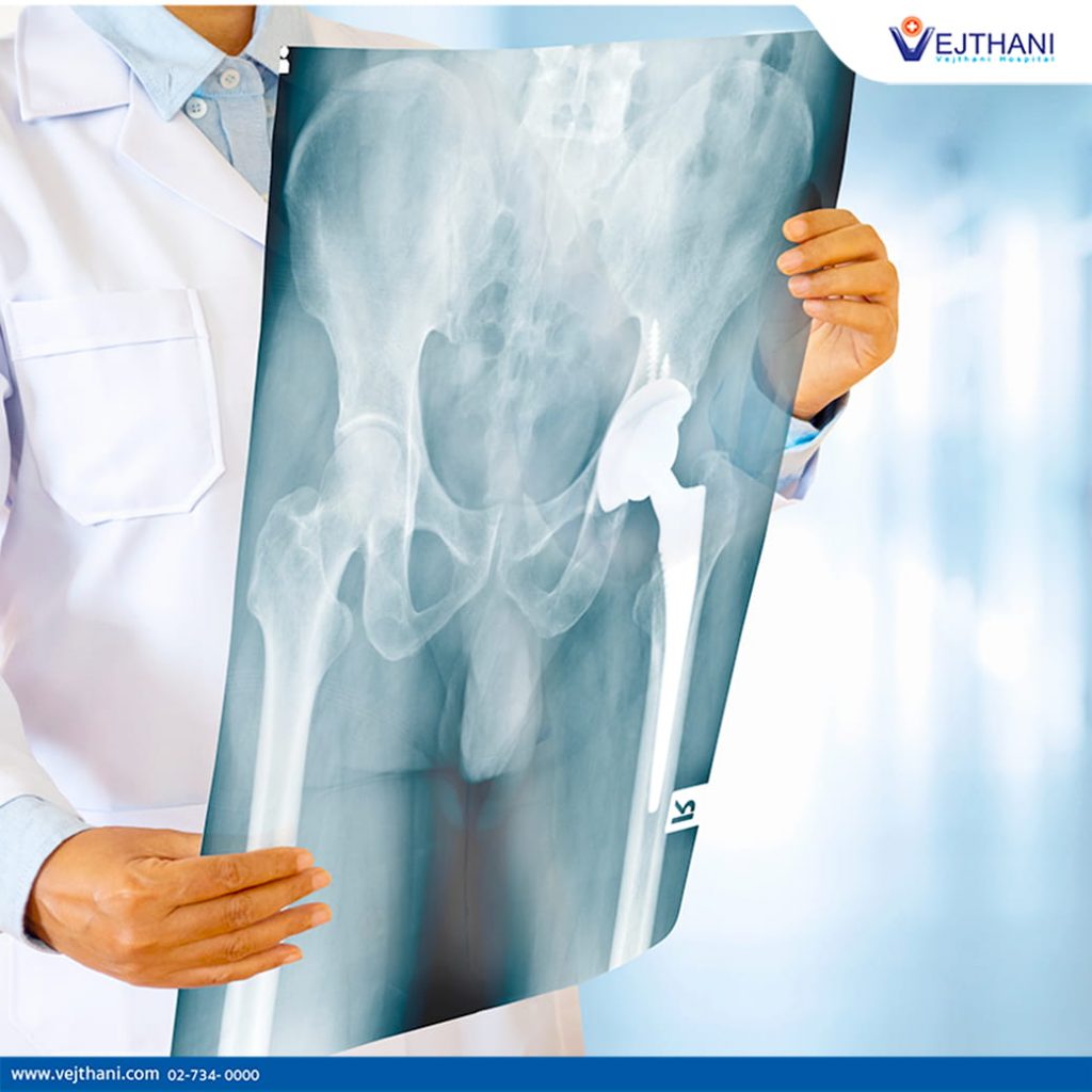 A doctor in a white coat examines an x-ray of a total hip replacement.