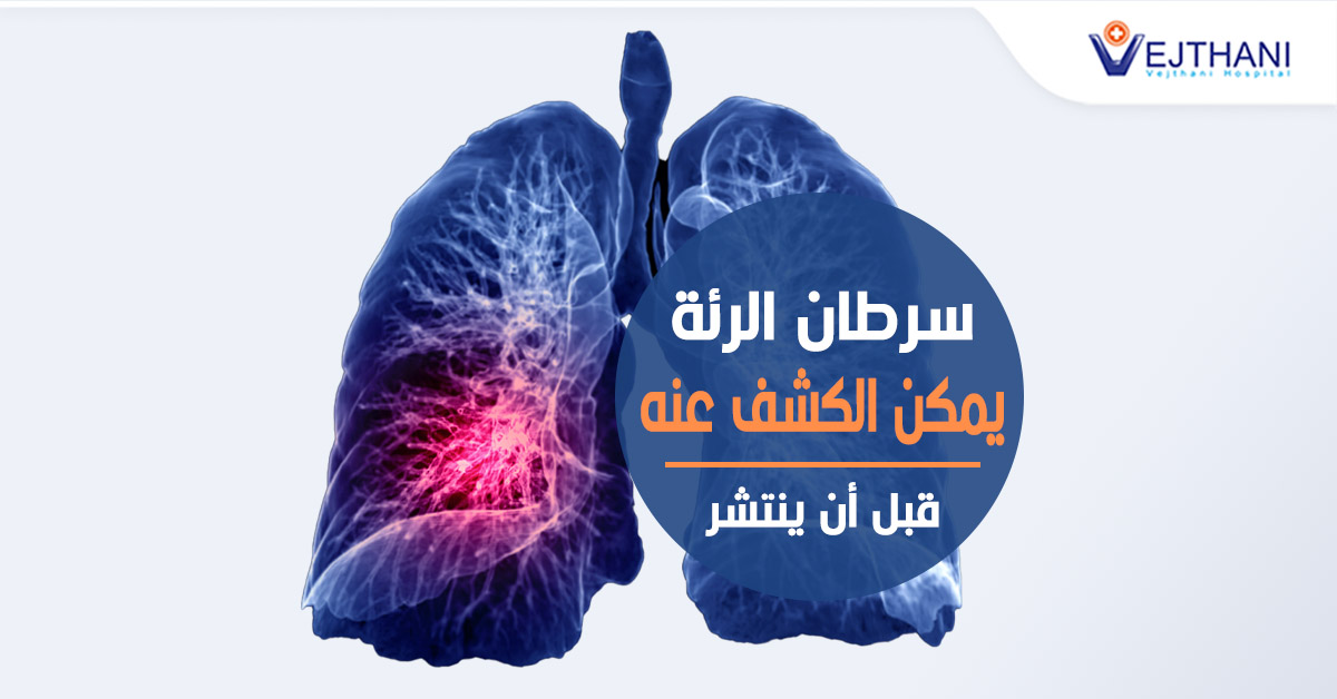 Lung cancer can be checked before it spreads