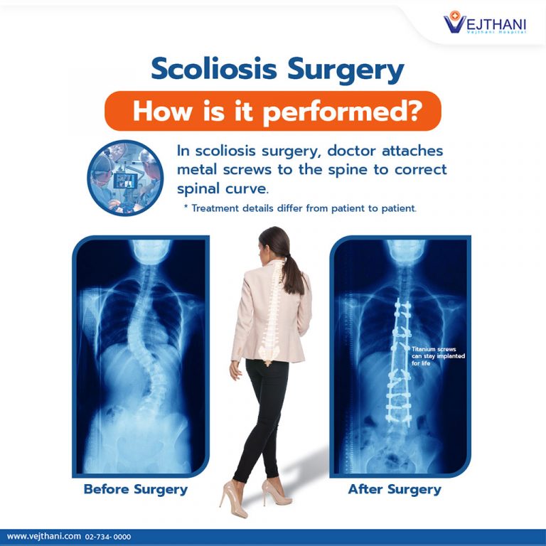 How Is Scoliosis Surgery Performed?