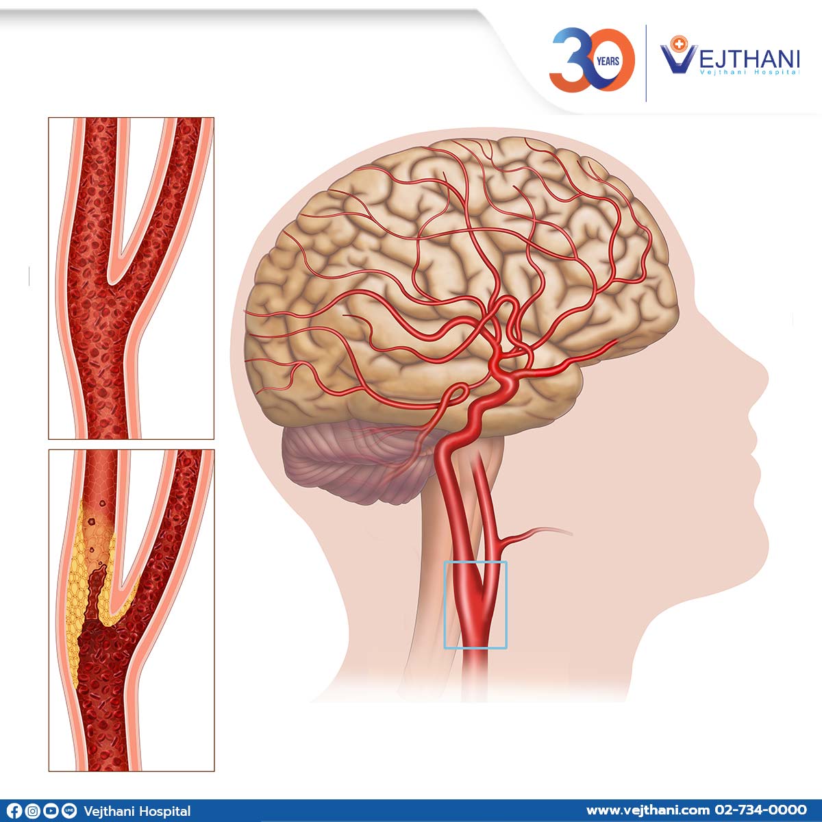 carotid artery treatment in thailand
