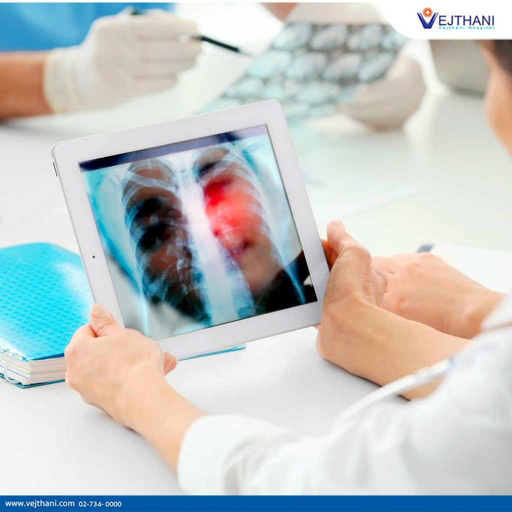 Vejthani Hospital can treat all stages of lung cancer.
