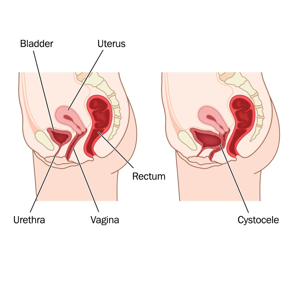 Medical Illustration Showing Difference Normal Uterus Prolapsed