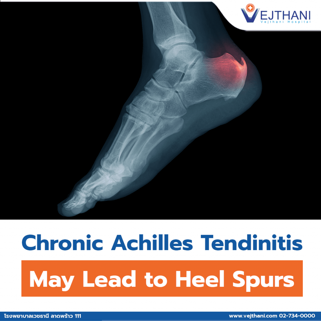 Achilles tendinitis - Wikipedia