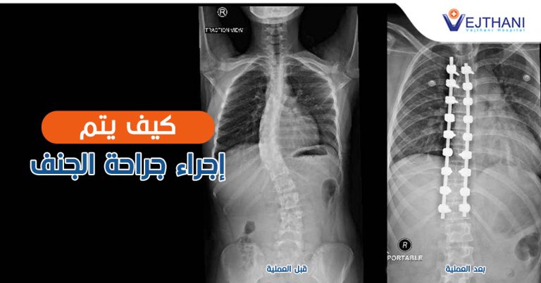 How Is Scoliosis Surgery Performed