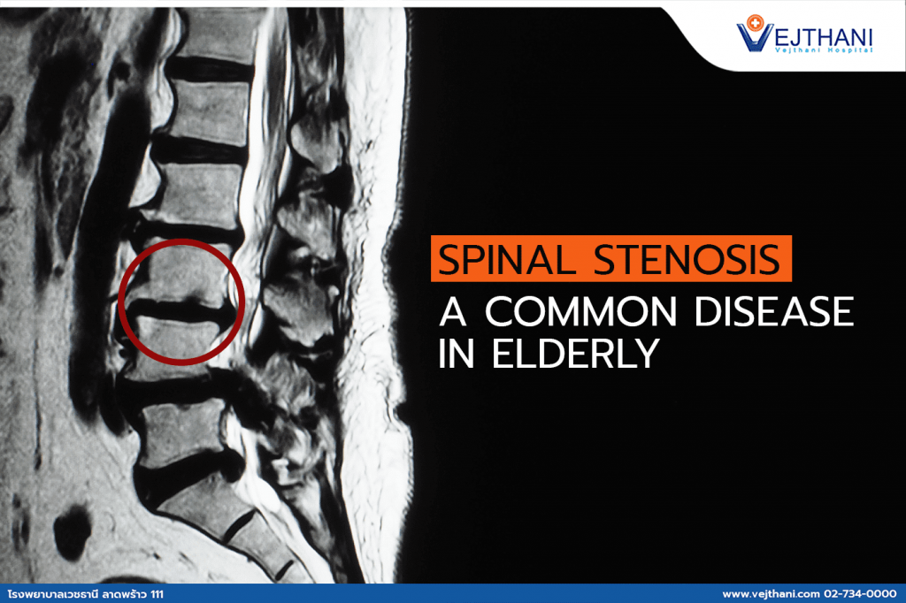 Spinal stenosis