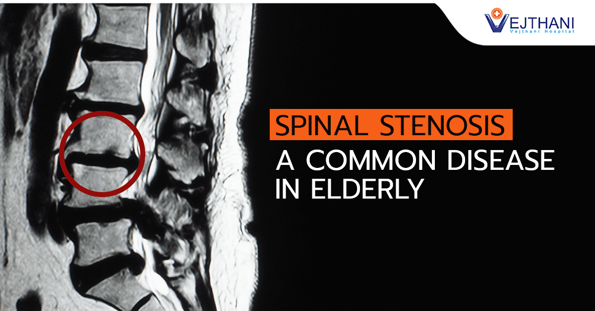 የአከርካሪ አጥንት መጥበብ ወይም ስቴኖሲስ (Spinal Stenosis) – በአረጋውያን ላይ የተለመደ በሽታ