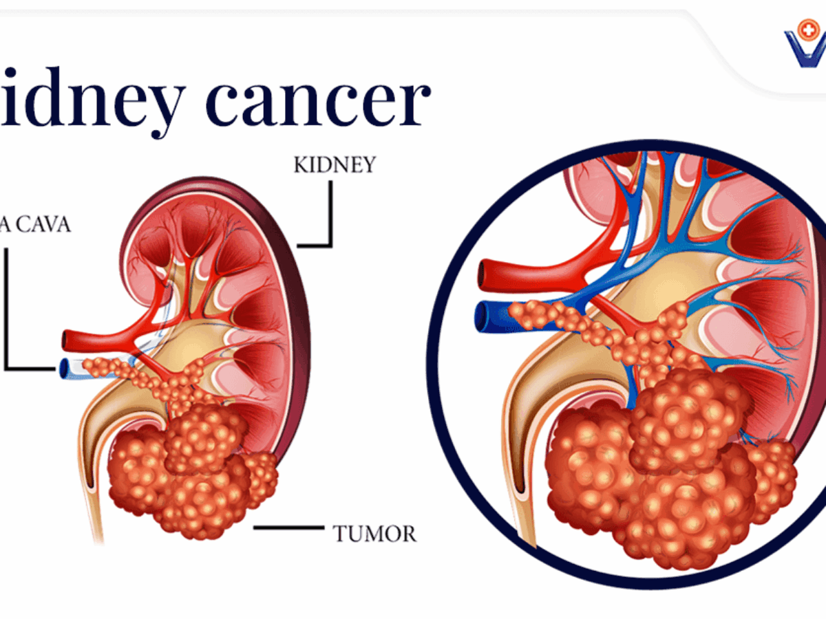 Time is of the Essence: Early Treatment Increases Chance of