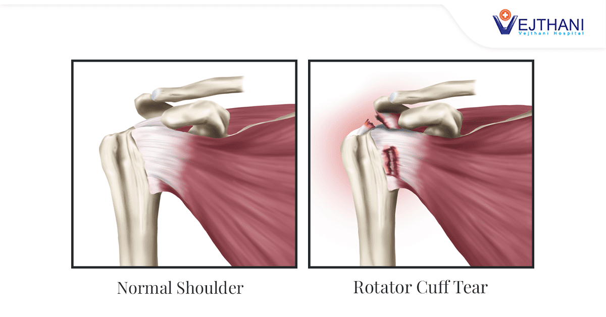 Treatment Methods for Rotator Cuff Tears - Vejthani Hospital  JCI  Accredited International Hospital in Bangkok, Thailand.