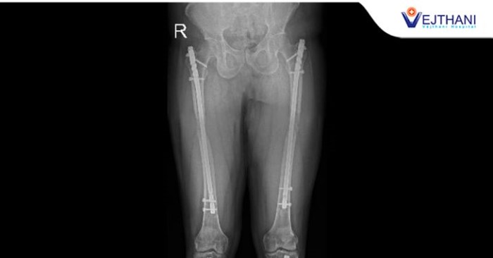 Limb Lengthening in Thailand