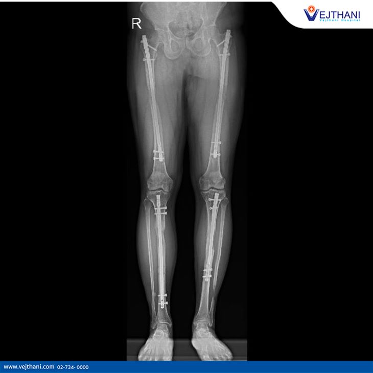 Limb lengthening allows children to grow normally.