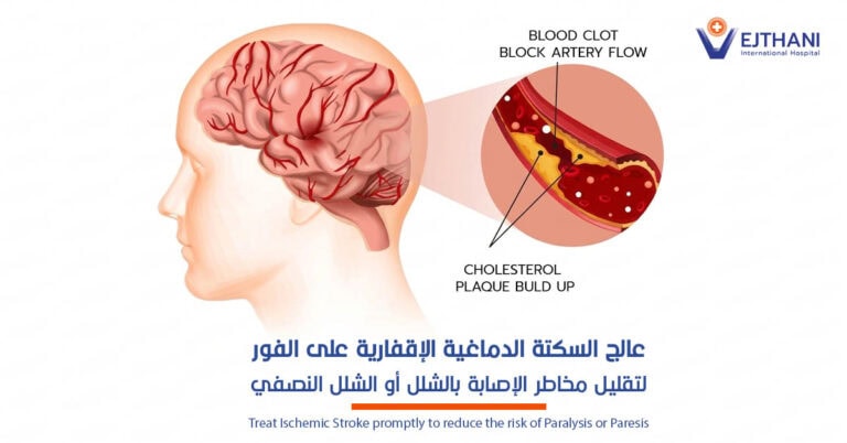 علاج السكتة الدماغية الإقفارية