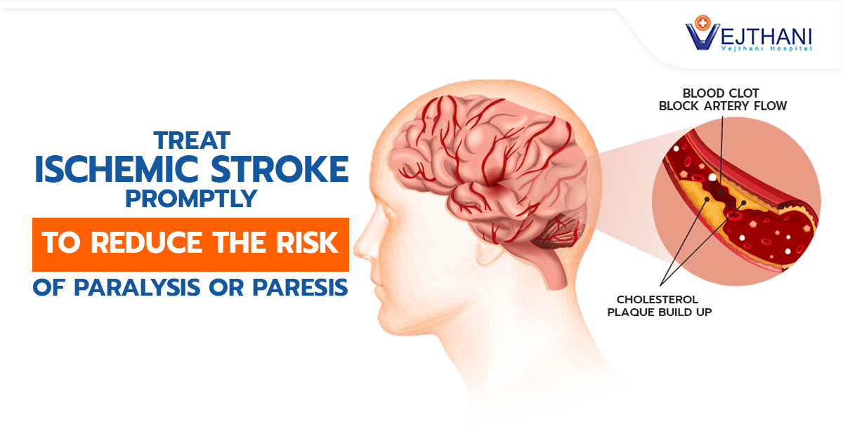 የሽባነት (paralysis) ወይም መንቀሳቀስ አለመቻል (paresis) ስጋትን ለመቀነስ አይስኬሚክ ስትሮክን (Stroke)ወዲያውኑ ያክሙ