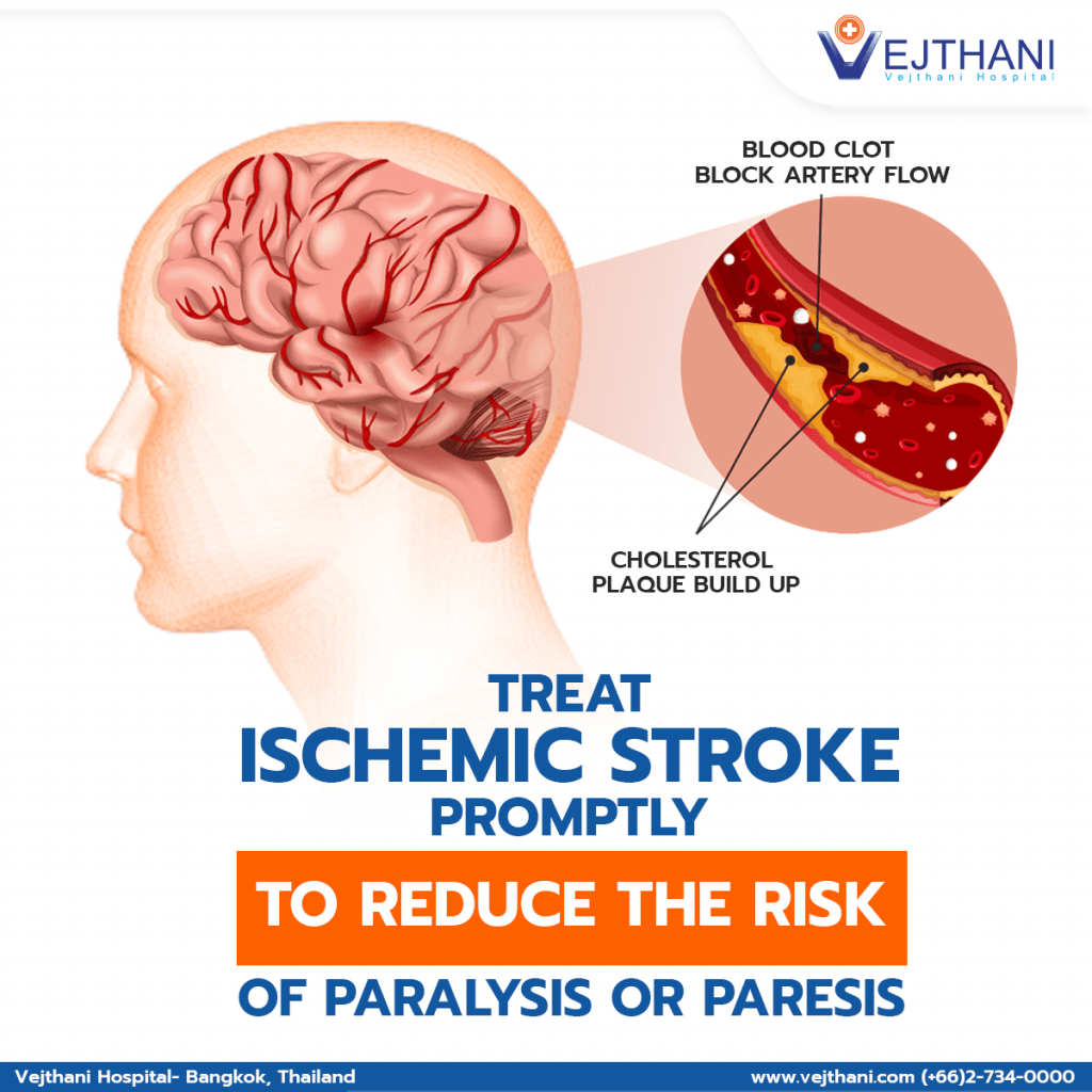 Ischemic Stroke Acute Ischemic Stroke kartoniertes Buch R hm Buch