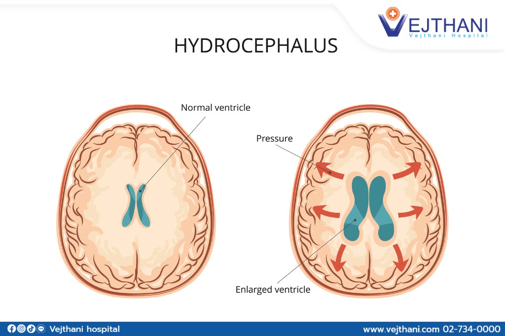 Hydrocephalus
