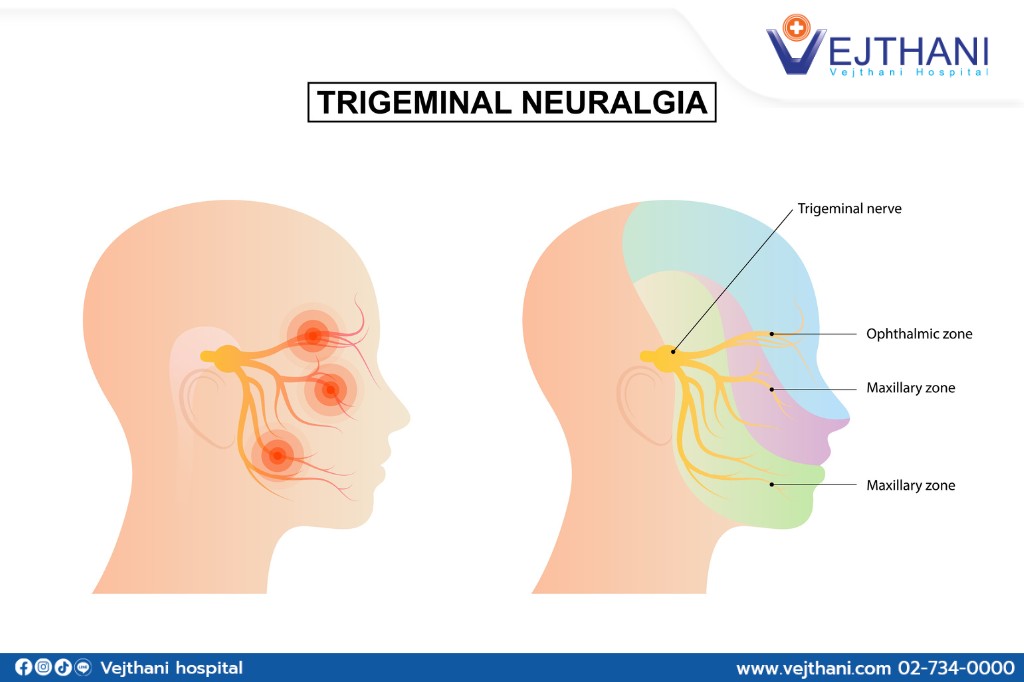 Trigeminal neuralgia