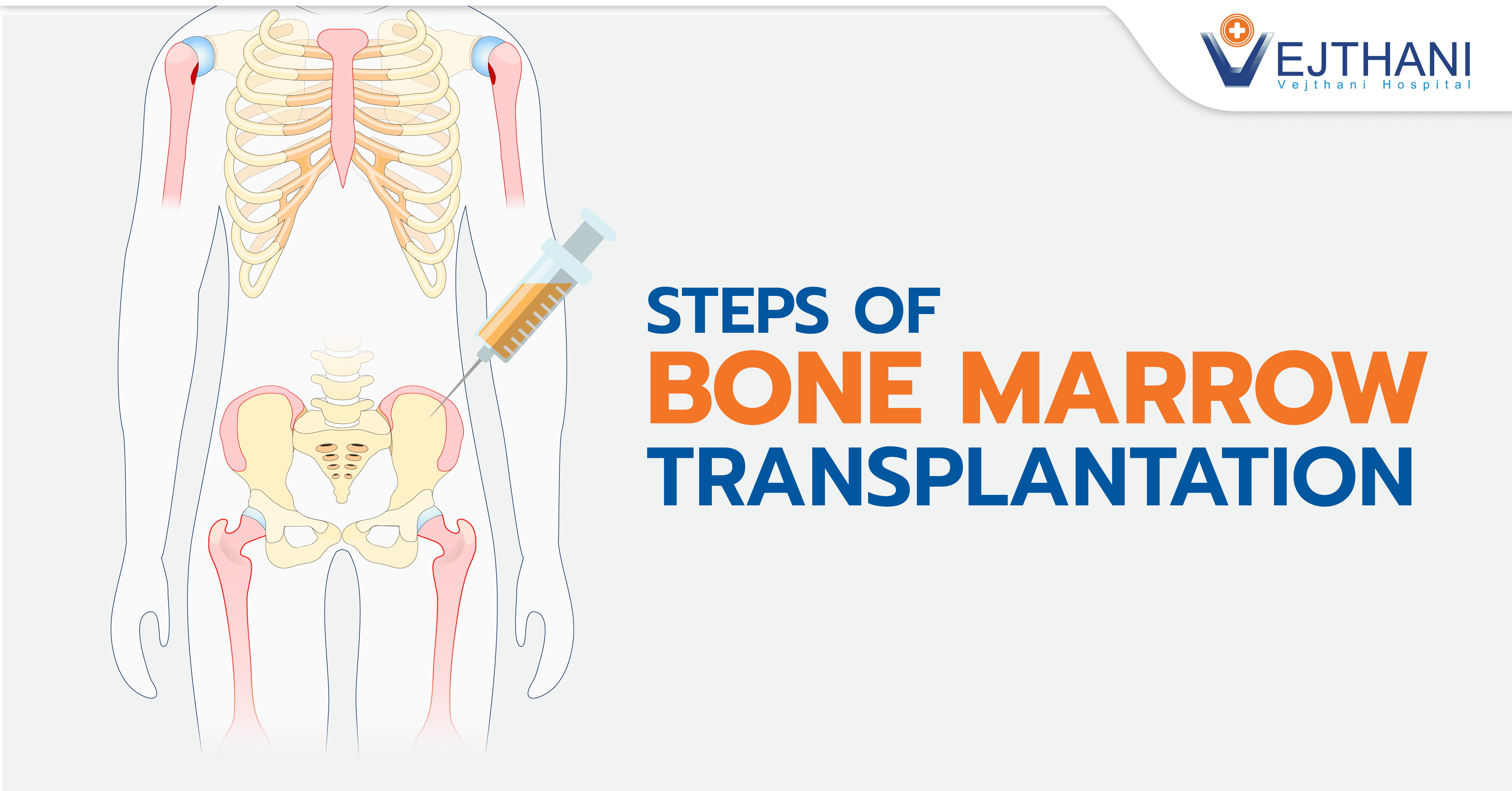 የአጥንት መቅኒ ንቅለ ተከላ (Bone Marrow Transplantation) ደረጃዎች