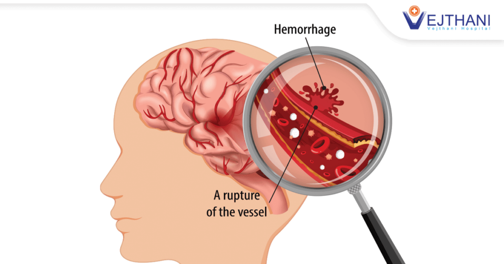 Brain Bleed After A Stroke | Hemorrhage After an Acute Ischemic Stroke ...