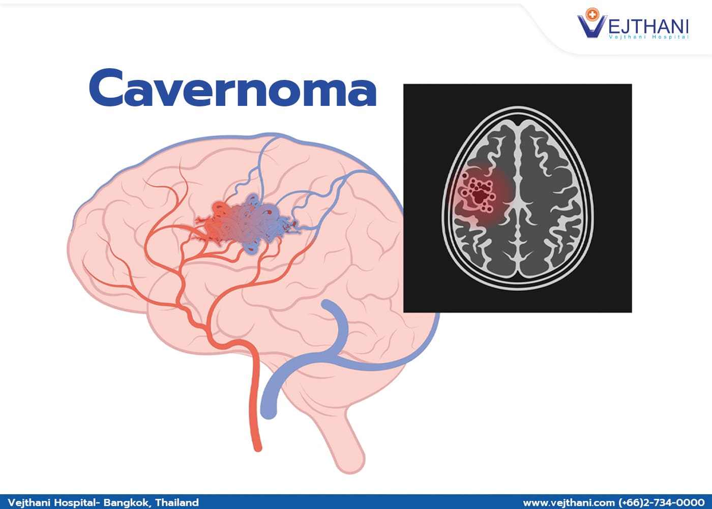 What Is A Cavernous Hemangioma 