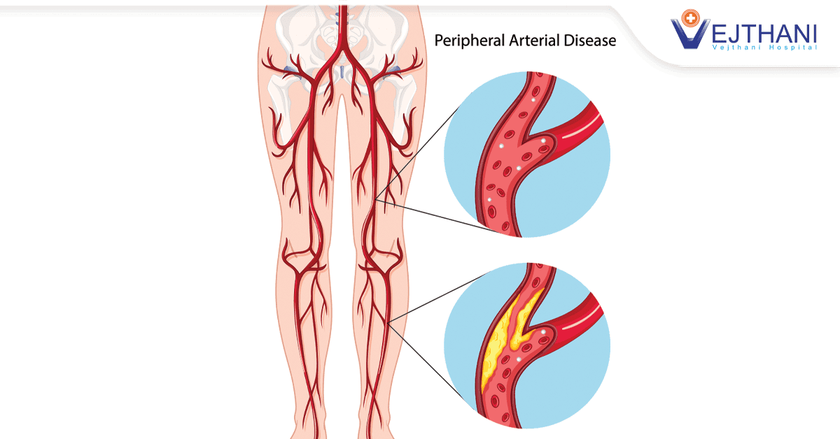 ፔሪፈራል የደም ቧንቧ በሽታ (Peripheral Artery Disease) ልንጠነቀቅበት የሚገባ የተለመደ የጤና ሁኔታ ነው